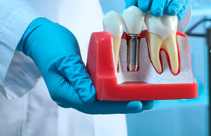 Российские ученые изобрели зубные протезы из ниобия и циркония 